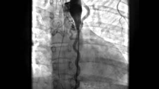 Coarctation of Aorta with Large Collaterals AP view [upl. by Eves]