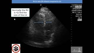 POCUS Cases 2 Pulmonary Embolism [upl. by Ebbarta379]