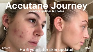 My Accutane Journey monthly updates progress pictures and a 5 year skin update [upl. by Ettennan924]