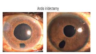 TThe many faces of secondary angleclosure glaucoma A practical approach to unveil [upl. by Waterman159]