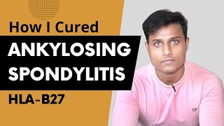 How I Cured My Ankylosing Spondylitis  Ayurvedic Treatment [upl. by Venus]