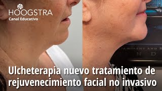 Ulcheterapia nuevo tratamiento de rejuvenecimiento facial no invasivo  23215 [upl. by Ebeneser]