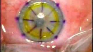 Lamellar Keratoplasty LK [upl. by Resay]