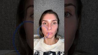 botox update for right masseter hypertrophy [upl. by Carol]