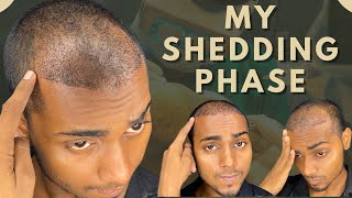 Shedding Phase  My Shedding Phase after 20 Days of Hair Transplant  Krishna Yadav Hair Transplant [upl. by Niu]