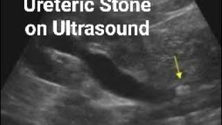 Ureteric stone on Ultrasound [upl. by Ilke]