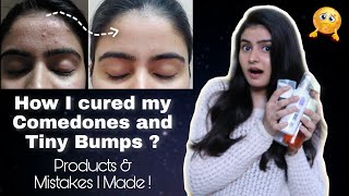 How to treat Tiny Bumps Comedones amp Skin Texture  Kashika Chauhan [upl. by Hedelman]