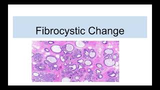 Fibrocystic Disease of Breast [upl. by Sucramal707]