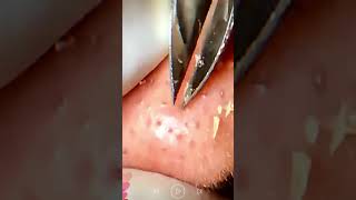 Skincare  Blackheads Removal 287 tweezers skincare blackheads blackheads [upl. by Home928]