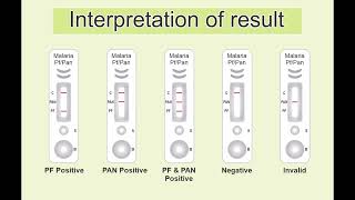 How to use a Malaria  PFAntigen Rapid Test [upl. by Mcgee]