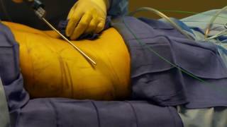 Liposuction Demonstration Laser Lipo Demonstration Part 6 of 6 [upl. by Molini6]