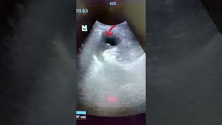 Splenic Cyst Ultrasound ultrasound shortvideo usg3d [upl. by Mccall]