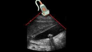 Ultrasound of Gallbladder amp Gallstone [upl. by Millie]