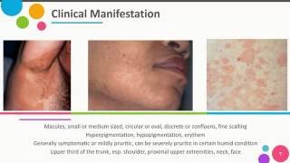 Pityriasis Versicolor by Gisti Respati Riyanti [upl. by Lleddaw156]