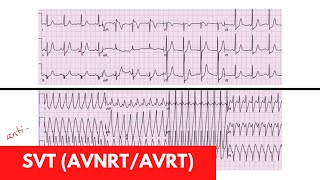 SVT AVRT AVNRT  For DO MD NP PA Part 3 [upl. by Gefell]