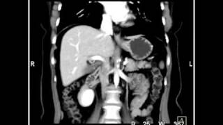 Abdomen Stomach Inferior epigastric arteries 3D Reconstruction for DIEP Block Surgery2 of 2 [upl. by Toddie]