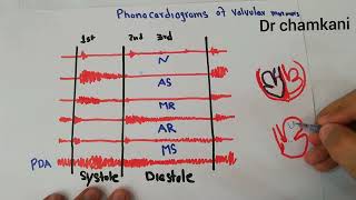 CVS 233  Phonocardiograms of valvular murmurs  Aortic and mitral [upl. by Uela]