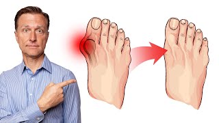 How to Fix Bunions in 3 Steps [upl. by Rosalyn740]