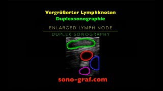 Duplexsonographie  Vergrößerter Lymphknoten [upl. by Anawyt779]