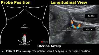 How To Scan The Uterine Artery  Doppler Ultrasound Probe Positioning  Transducer Placement USG [upl. by Shelburne]