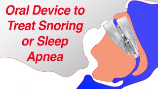 Mandibular Advancement Device MAD to Treat Snoring and Sleep Apnea [upl. by Leizo]