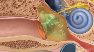 Ruptured eardrum perforated eardrumTreatment for eardrum rupture [upl. by Ahsienot567]