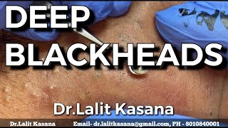 DEEP OLD BLACKHEADS REMOVAL BY DrLalit Kasana 24 Jan 2020 [upl. by Pan]