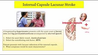 12DaysinMarch Stroke Localization Lacunar Infarcts Part 2 of 3 for the USMLE Step One Exam [upl. by Etnaed]