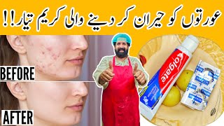 How To Remove Pimples Overnight  Acne Treatment  Remove Dark Spots 100 Effective  BaBa Food RRC [upl. by Ecnedurp661]