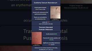 Erythema Toxicum Neonatorum vs Transient Neonatal Pustular Melanosis [upl. by Karl]