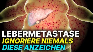 Lebermetastase Diese Symptome NIEMALS ignorieren [upl. by Mcbride592]