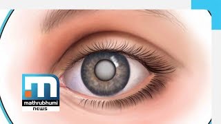 Cataract Symptoms And Treatments Doctor 2PMMathrubhumi News [upl. by Conlon]