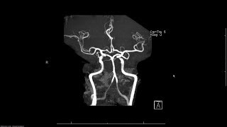 MRA magnetic resonance angiogram head radiology search pattern [upl. by Eirrotal]