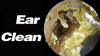 Ear Picking Its Been So Long Since Ive Cleaned It Out That The Earwax Is Getting Infected In There [upl. by Atikram]