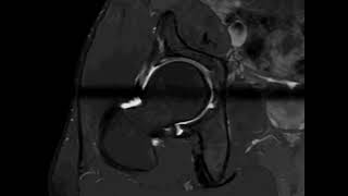 Mri hip arthrography radial sequence [upl. by Acimot]