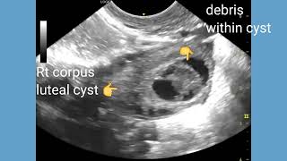 Viable intrauterine pregnancy with corpus luteal cyst of ovary ultrasound and color Doppler video [upl. by Dysart912]