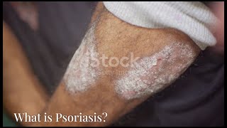 psoriasis explaining psoriasis Signs Symptom and treatment [upl. by Cirillo644]