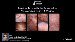 Treating Acne with the Tetracycline Class of Antibiotics A Review [upl. by Ahsem]