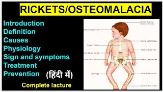 Osteomalacia  Rickets Disease Complete lacture In Hindi For Nursing GNM MBBS  Nursing Education [upl. by Ahsetan503]