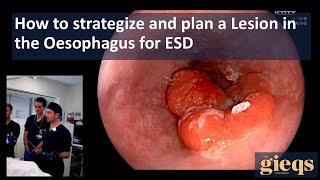 How to strategize and plan a Lesion in the Oesophagus for ESD [upl. by Odlanyar]