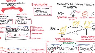 Asthma  signs and symptoms pathophysiology [upl. by Ahseryt]