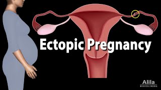 Ectopic Pregnancy Animation [upl. by Narhet197]