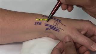 1st CMC Joint Injection [upl. by Eissolf]