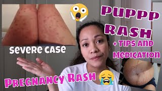 PUPPP RASH DURING PREGNANCY😭  TIPS TO LESSEN ITCHINESS  MEDICATION  BEFORE amp AFTER SKIN CONDITION [upl. by Towrey]