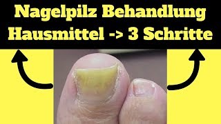 Nagelpilz Behandlung Hausmittel ✔ 3 Schritte um ekligen Nagelpilz loszuwerden [upl. by Airyk]