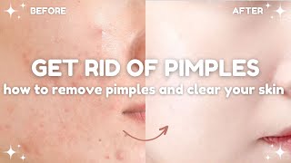 how to get rid of pimples and clear your skin 🧴🫧 acne treatments and dos and donts [upl. by Namia]