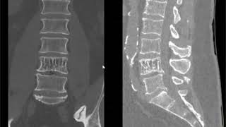 Spine lecture hemangioma of spine [upl. by Stroup227]