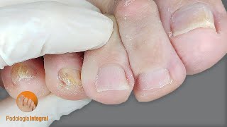 Fallen metatarsus  plantar corns and calluses  Affected skin and toenails  Comprehensive Podology [upl. by Odinevneib579]