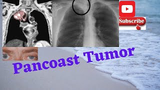 PANCOAST TumorWhat are the symptomsWhere does Pancoast tumor hurt usmle neetpg plab fmge [upl. by Labannah]