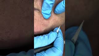 Watch Electrolysis Hair Removal in Action [upl. by Gorrian]